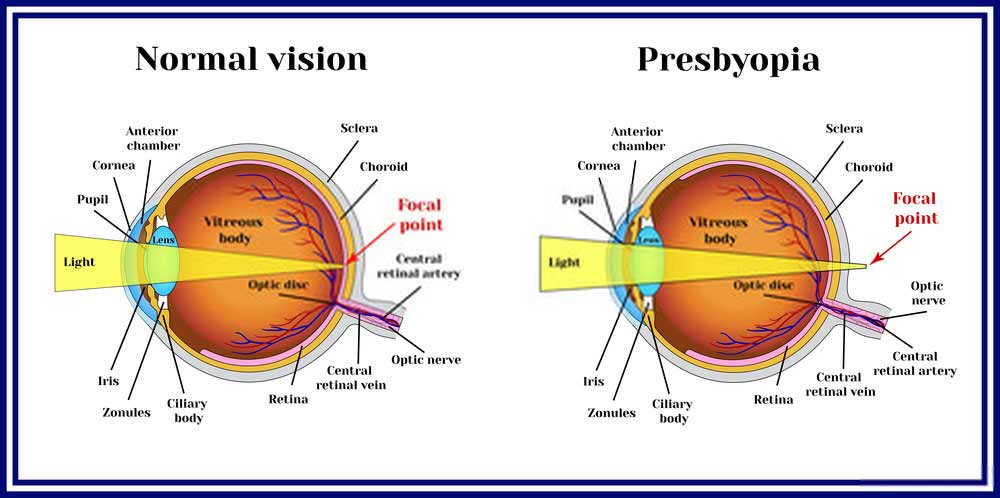 presbyopia vs normal vision cant see well older
